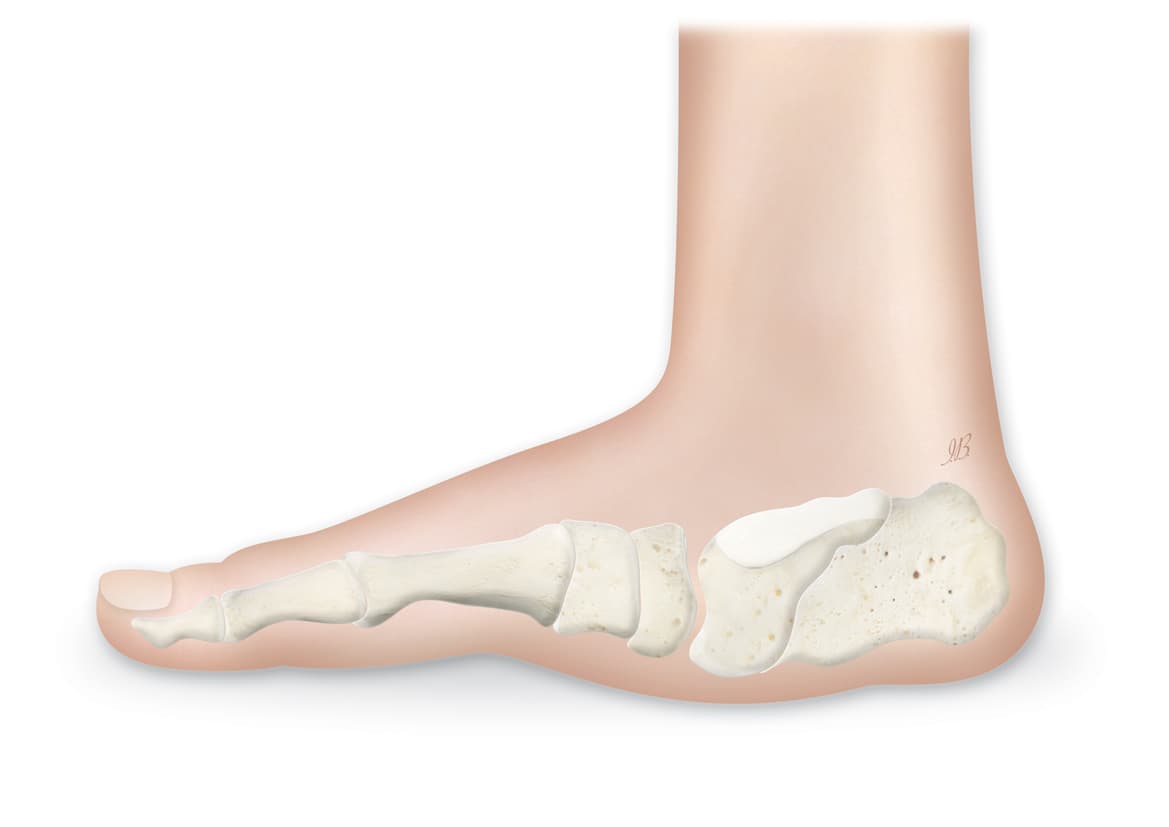 Charcot foot