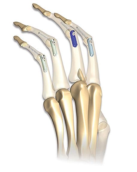 Hand & Wrist