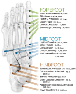 NeoSpan SE Compression Staples for Foot