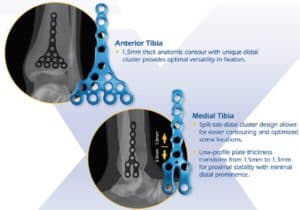 Omni Stable AF – Ankle Fracture System