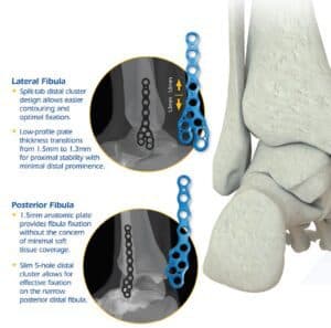 Omni Stable AF – Ankle Fracture System
