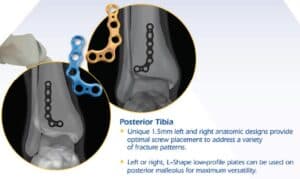 Omni Stable AF – Ankle Fracture System