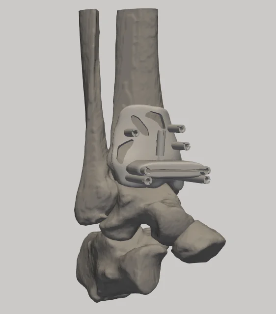 3D-Side Patient-Specific Instruments (PSI)