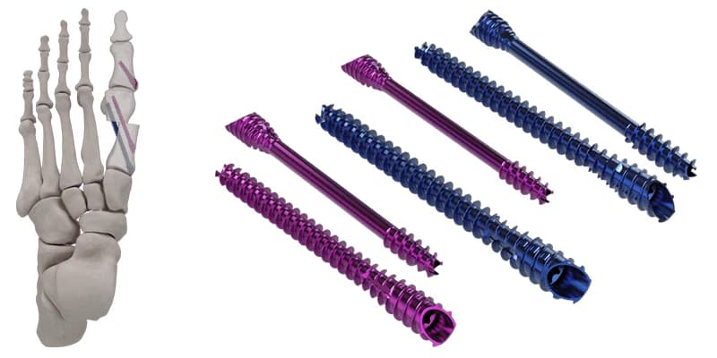 IBS-B™ MIS Beveled Screw System