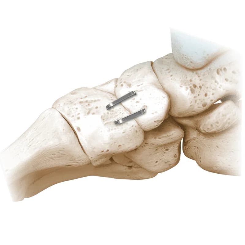 NeoSpan® SE Compression Staples for Foot