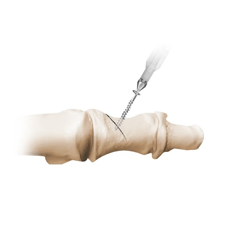 NeoSys® – I.B.S.™ Screws with Single-Use Instruments