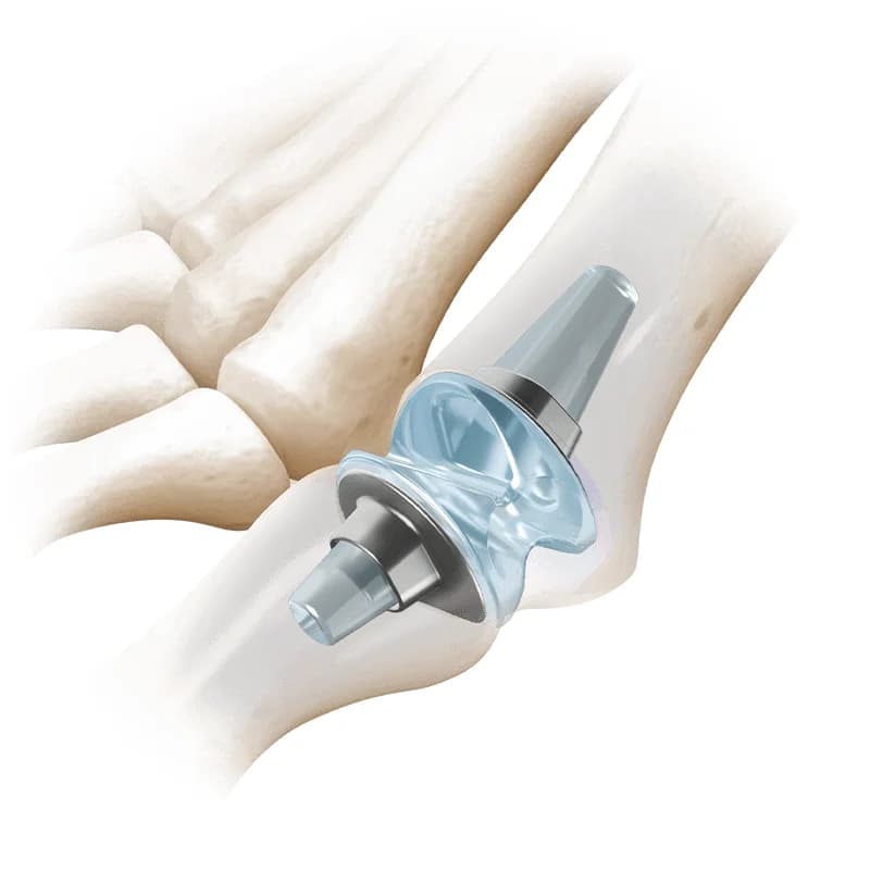 RTS® 1st MTP Joint Replacement