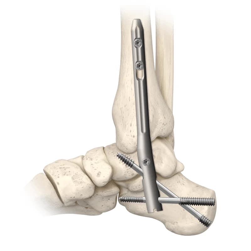 TriWay® Ankle Fusion Nail