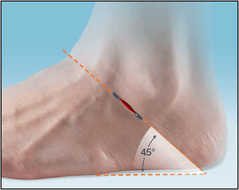 PitStop Subtalar Implant
