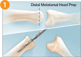RTS Lesser Toe – MTP Joint Replacement