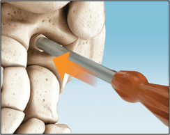 PitStop Subtalar Implant