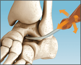 PitStop Subtalar Implant