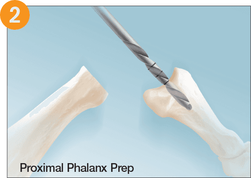 RTS Lesser Toe – MTP Joint Replacement