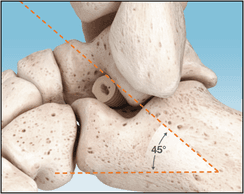 PitStop Subtalar Implant
