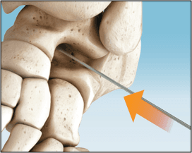 PitStop Subtalar Implant