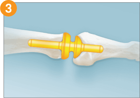 RTS Lesser Toe – MTP Joint Replacement