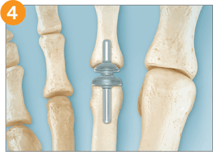 RTS Lesser Toe – MTP Joint Replacement