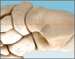 PitStop Subtalar Implant