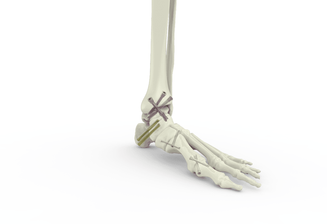 Mid-foot