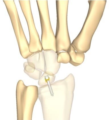CarpalFiX™ – Carpal Fusions