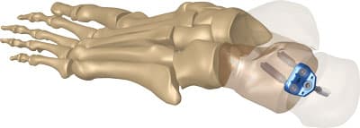 IO FiX TRIO – Calcaneal Osteotomy Plate