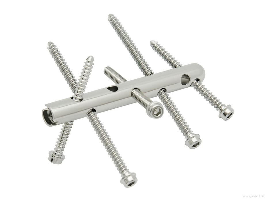 C-NAIL – Intraarticular Calcaneal Fixation