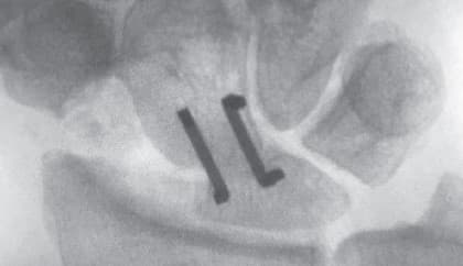 NeoSpan® SE Compression Staples for Hand