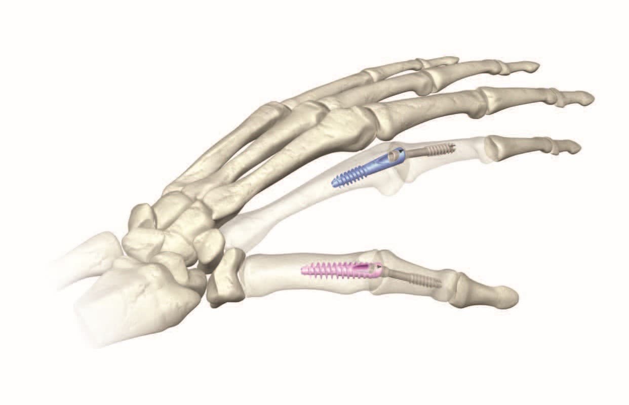XMCP™ – Metacarpal Phalangeal Fusion