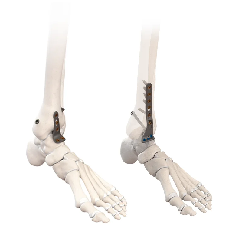 CoLink® NeoFuse – Ankle Fusion Plating