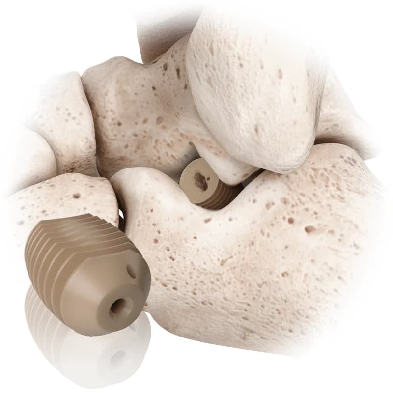 PitStop™ Subtalar Implant