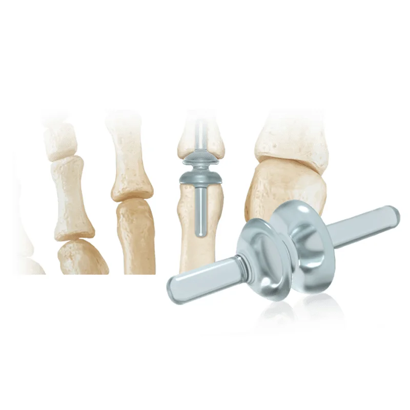 RTS® Lesser Toe – MTP Joint Replacement
